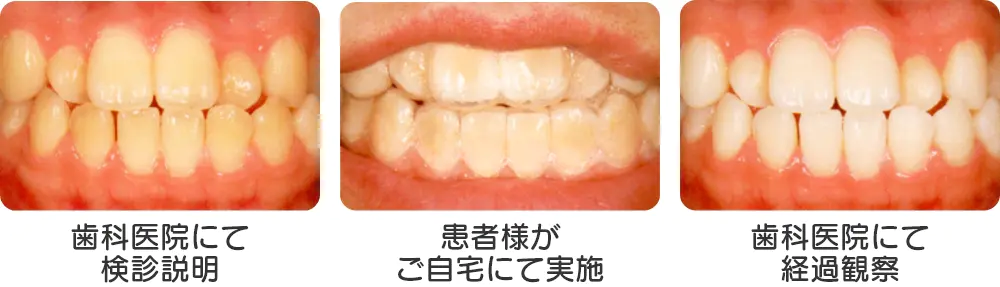 ホワイトニング